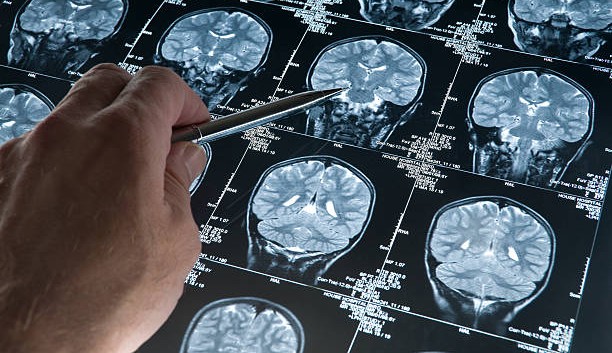 Estudo descobre 42 genes ligados ao Alzheimer