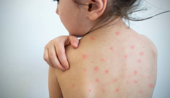 Sarampo: autoridades de saúde brasileira estão em alerta