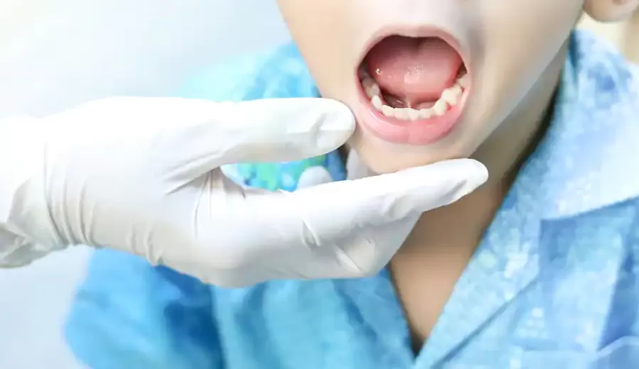 Anquiloglossia: Saiba mais sobre a condição da “língua presa”