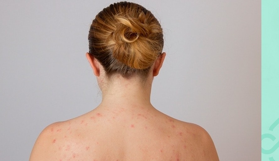 Descubra como evitar o aparecimento de acne nas costas
