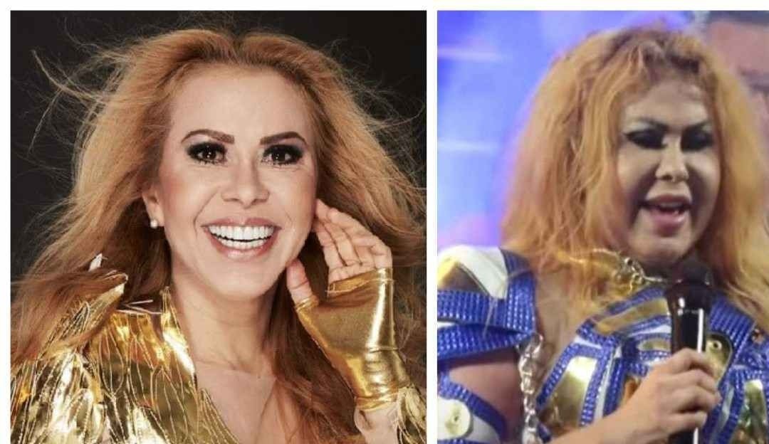 Entenda mais sobre o inchaço relatado por Joelma
