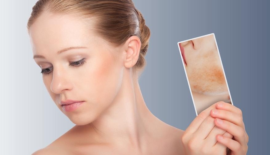 Saiba a diferença entre Acne e Rosácea
