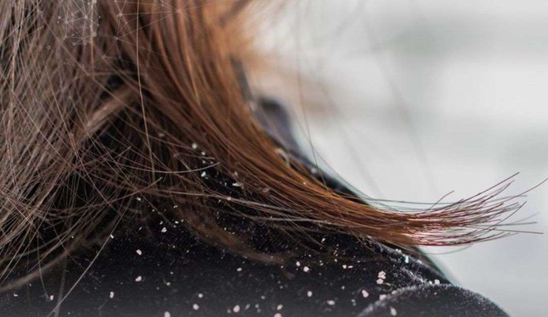 Saiba mais sobre a dermatite seborreica e como melhorar os sintomas