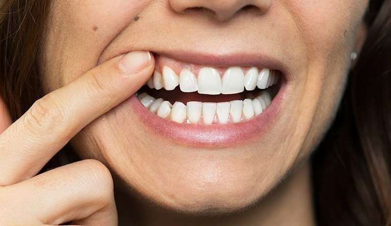 Conheça as vantagens dos implantes dentários