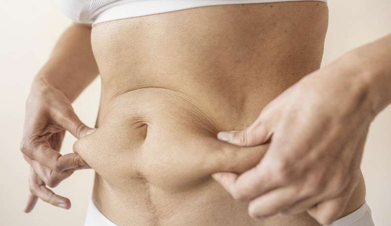 Cirurgia plástica corrige diástase abdominal