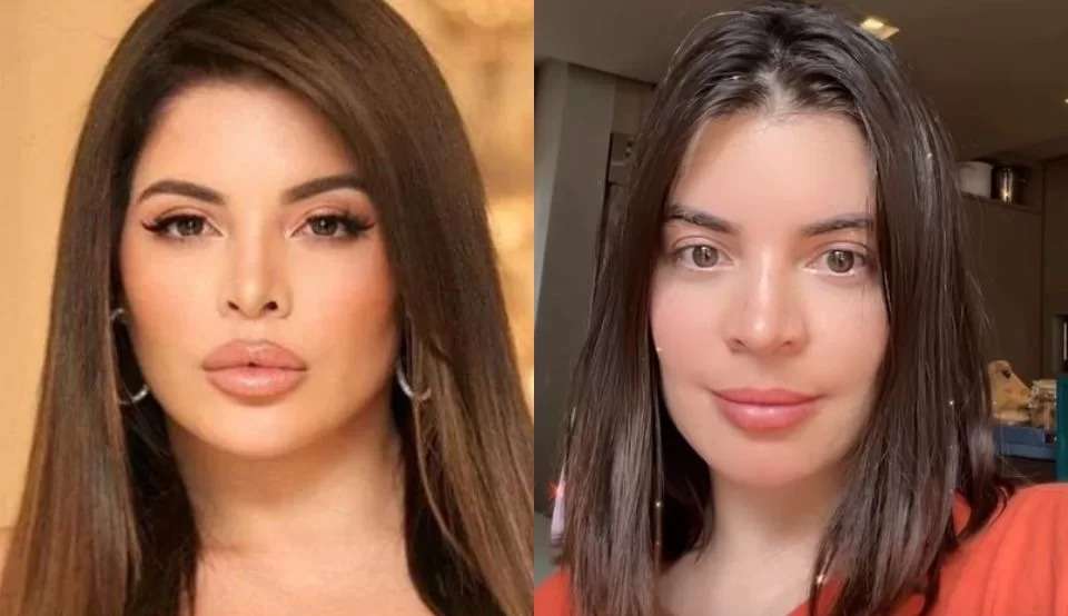 Remoção de preenchimento labial: entenda o procedimento realizado por Gkay