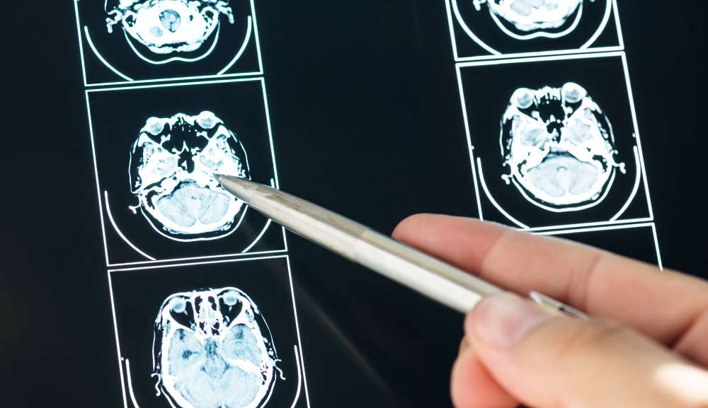 Obesidade pode alterar o cérebro da mesma forma como o Alzheimer