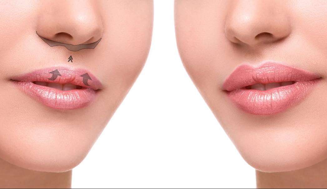 O que é o Lip Lift e por que ele é melhor do que o preencimento labial