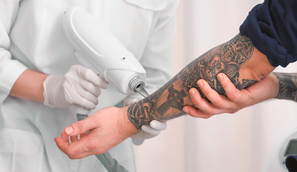 Saiba o melhor jeito de remover a sua tatuagem