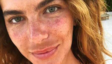 Descubra o que é o melasma e como tratar