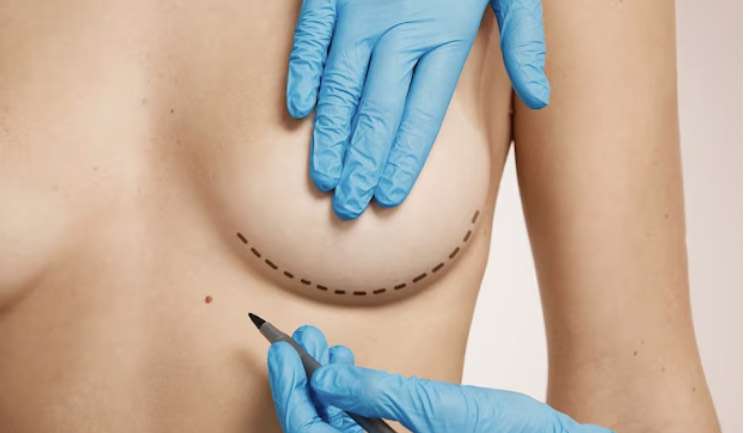 Cirurgia para retirada de prótese de silicone aumenta em 33%