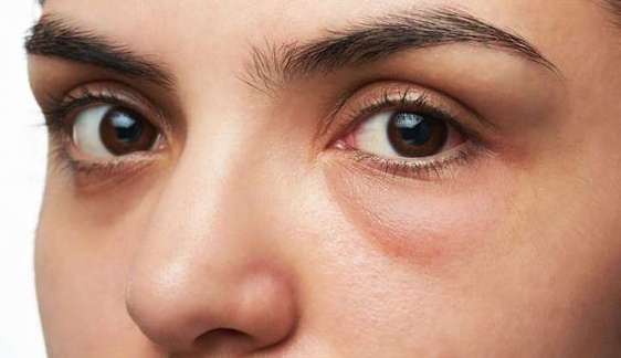 Conheça produtos naturais que ajudam no tratamento de olheiras
