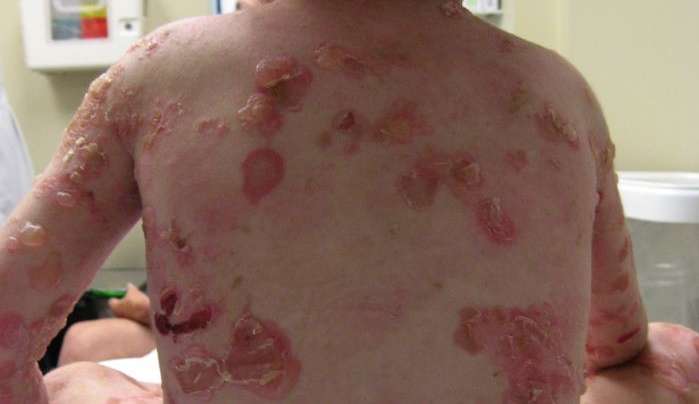 O que é a epidermólise bolhosa, doença rara que afeta garoto que passou 16 dias em coma
