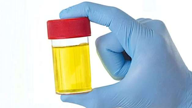 Cores, aspecto e cheiro da urina podem sinalizar desidratação a problemas renais