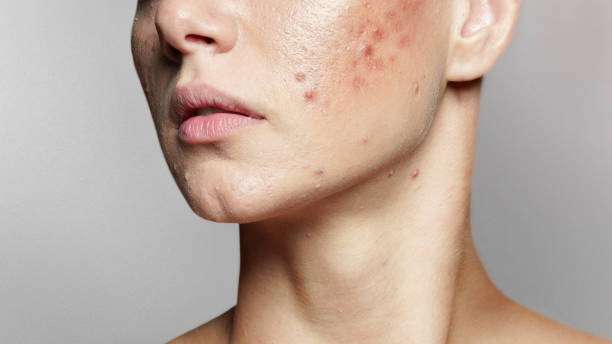 Acne: usar colírio para suavizar espinhas, pode dar alergia e irritação na pele