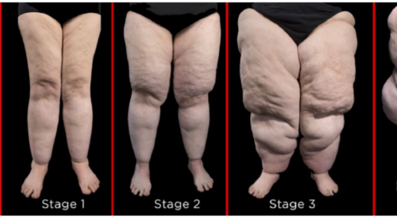 Lipedema: entenda a doença que afeta milhões de mulheres no Brasil