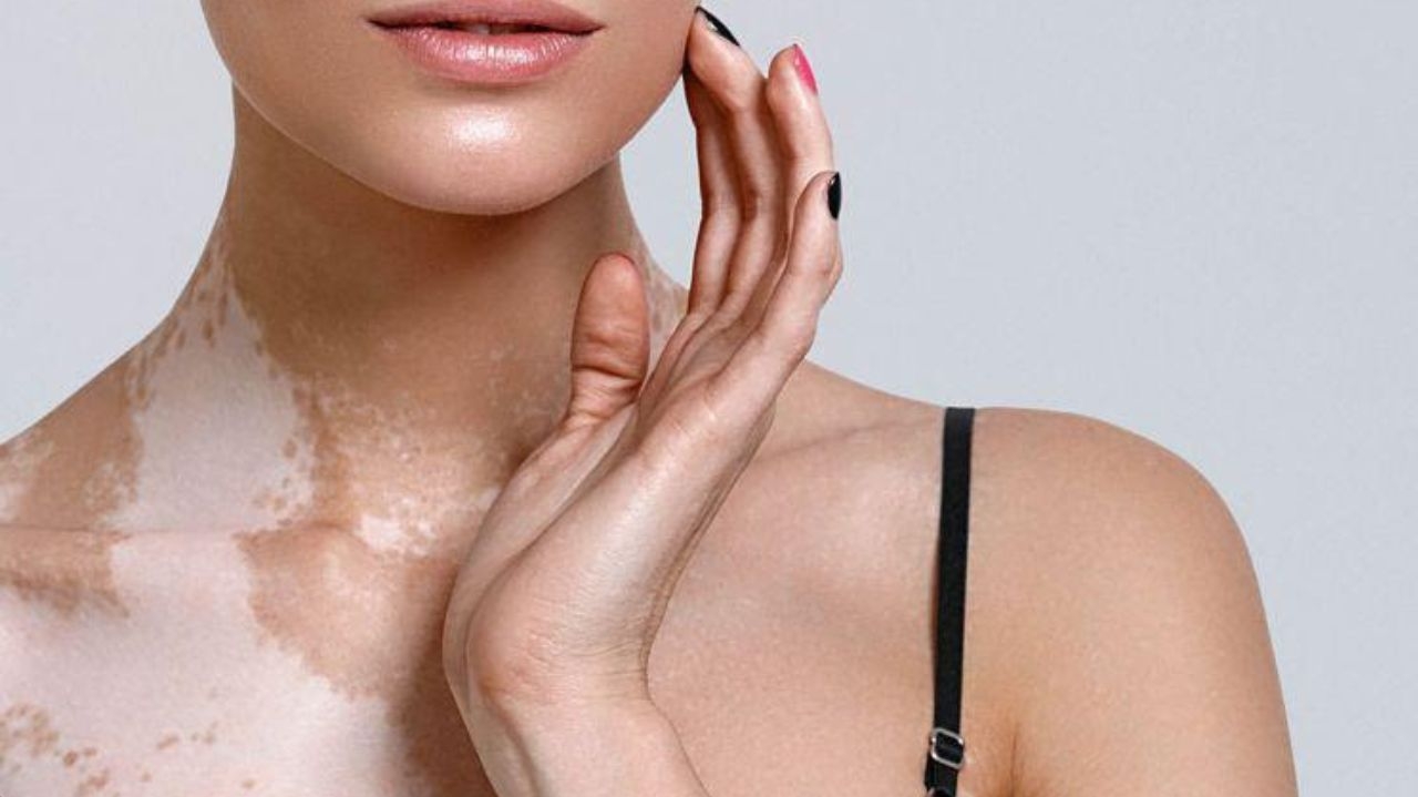 No Dia Nacional do Vitiligo, entenda sobre a doença e saiba as causas dela
