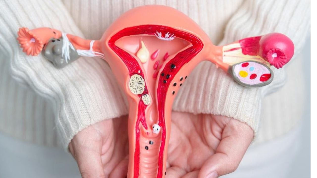 Síndrome dos ovários policísticos: saiba sobre a doença que pode causar obesidade e afeta a fertilidade da mulher