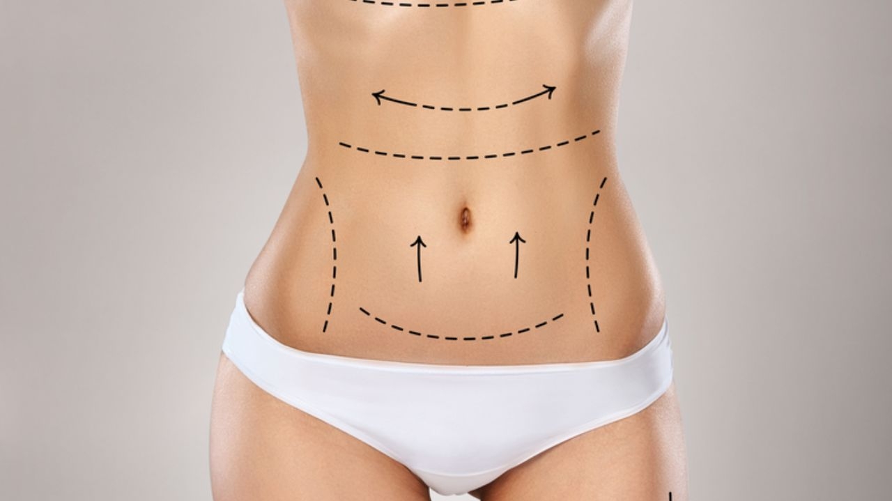 Pós-bariátrica: cirurgia plástica para excesso de pele