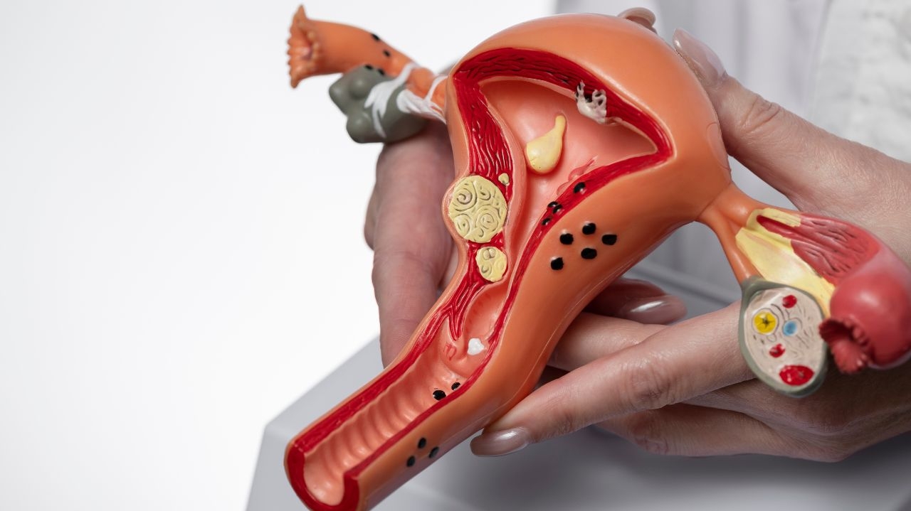 Entenda por que a endometriose pode causar infertilidade nas mulheres