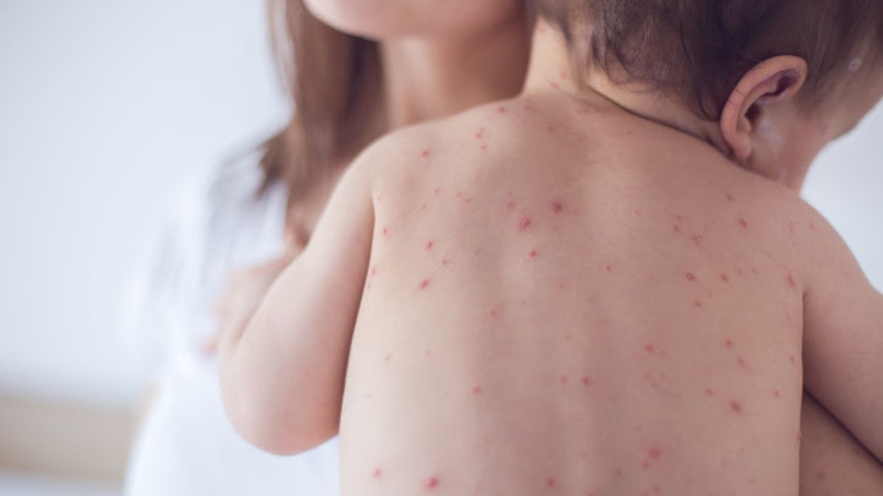 Com o fim do inverno, casos de catapora aumentam: saiba como se proteger