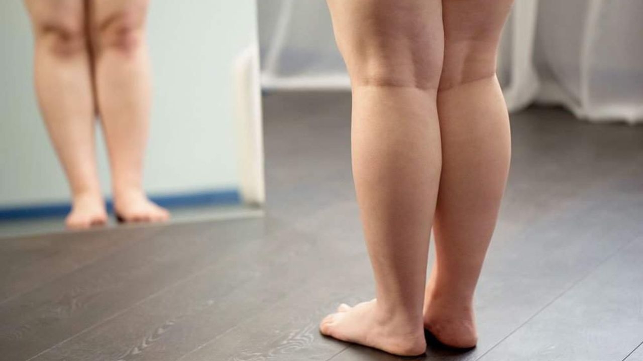 3 problemas comumente confundidos com lipedema e como diferenciá-los