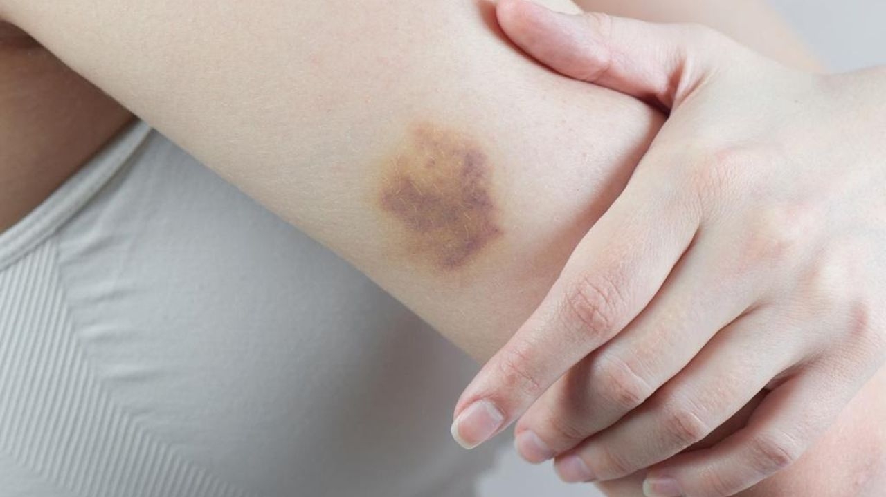 Hematomas: quando as manchas roxas são motivo de preocupação
