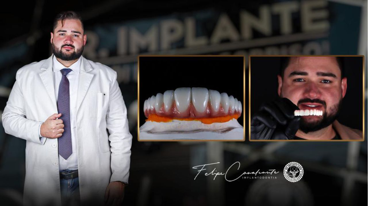 Dentes fixos sob implantes traz melhora na saúde bucal de pacientes