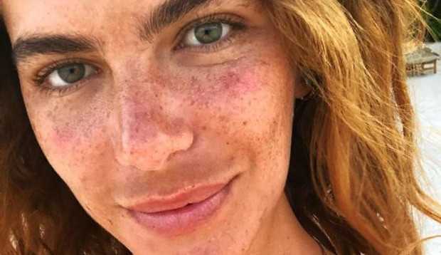 Melasma: entenda como controlar e prevenir este vilão