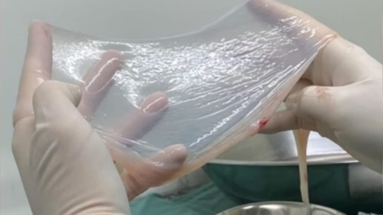 SUS oficializa uso da membrana amniótica como curativo biológico no tratamento de queimaduras