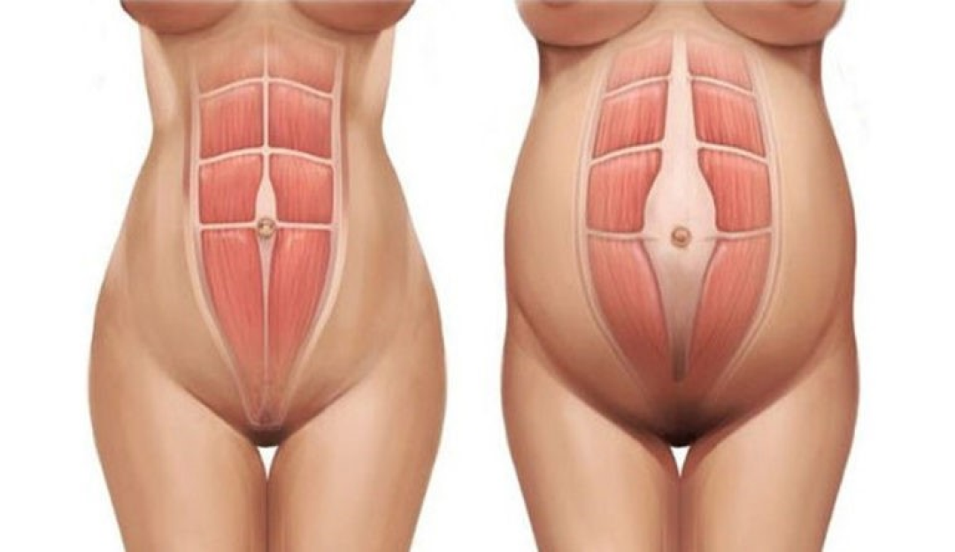 Dr. Matthews Herdy tira dúvidas sobre a diástase abdominal e o tratamento